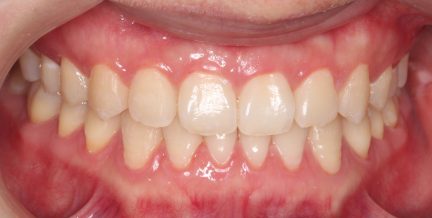 After Picture Anterior Crossbite Orchard Dental Care Centennial, CO