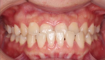 Before Picture Anterior Crossbite Orchard Dental Care Centennial, CO