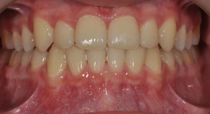 Orthodontic After Picture Straight Teeth Orchard Dental Care Centennial, CO