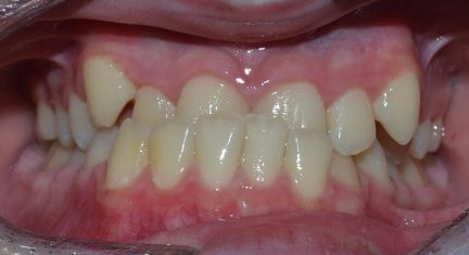 Orthodontic Before Picture Complex 