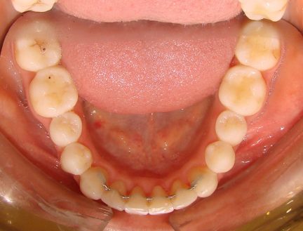 Dental Teeth Crowding After Picture Orthodontist Centennial, CO