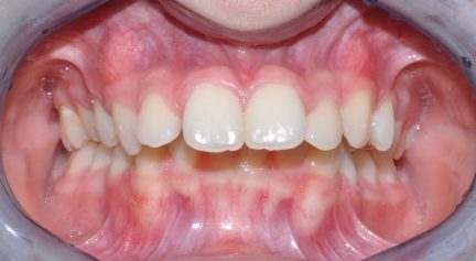 Cosmetic Dentistry Before Picture Overjet Orchard Dental Care Centennial, CO