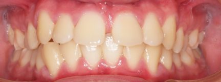 Orthodontic Before Picture Front Teeth Spacing 